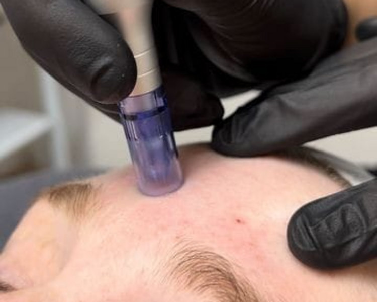 Dermapen