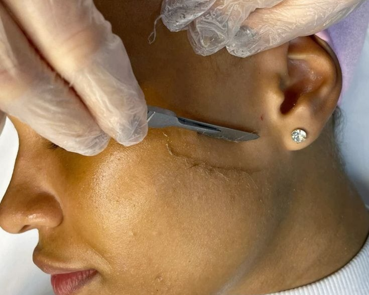Dermaplaning