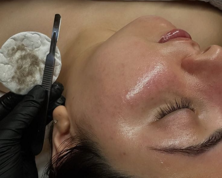 Dermaplaning