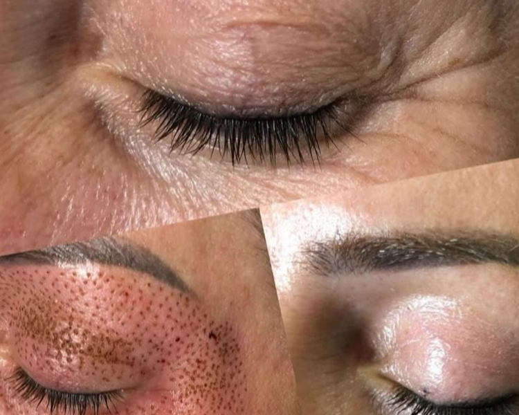Plasma Pen Rostro o Cuello