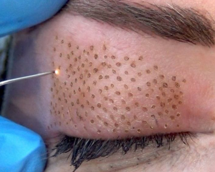 Plasma Pen Rostro o Cuello