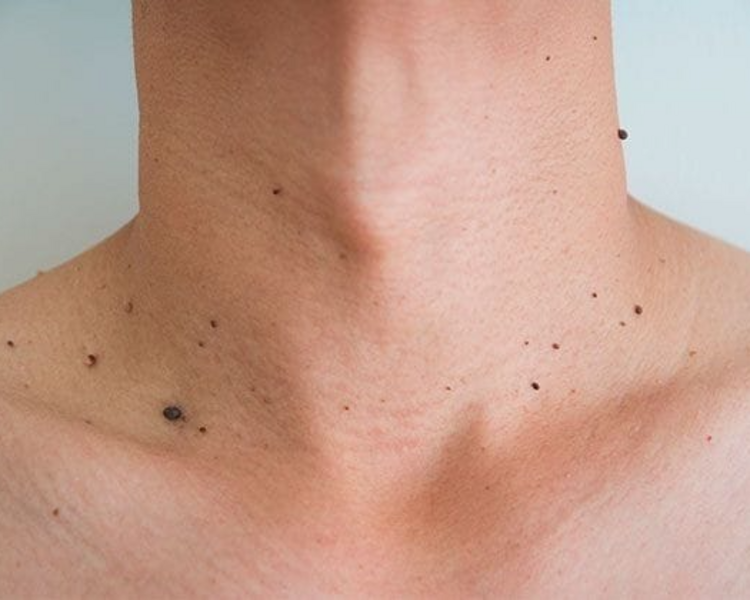Plasma Pen Rostro o Cuello