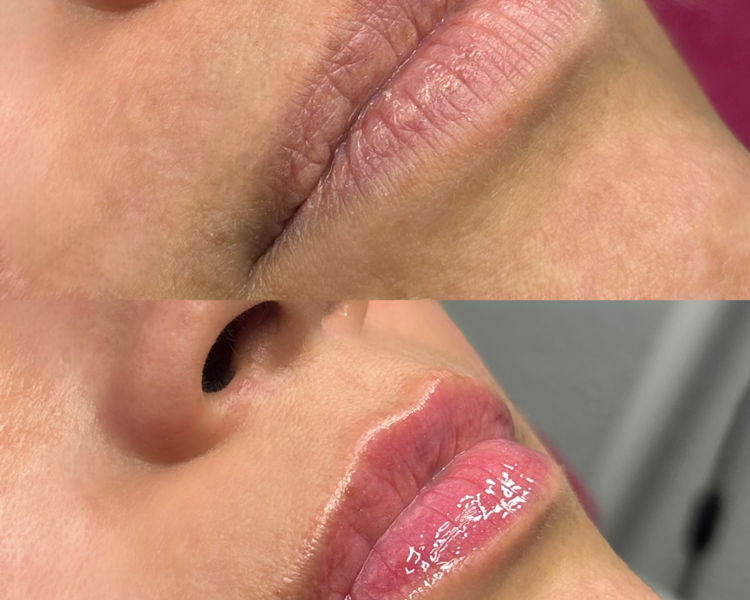3 sesiones HidraLips Gloss