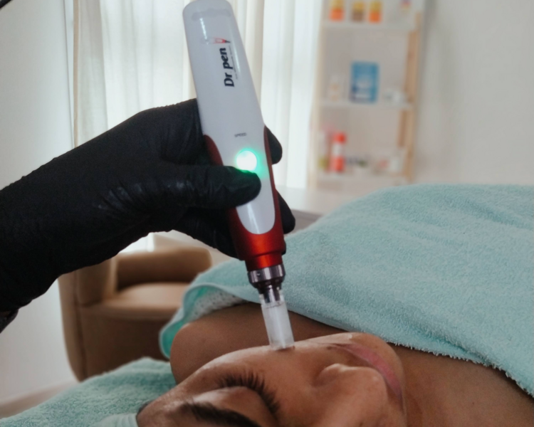 Microneelding (Dermapen)