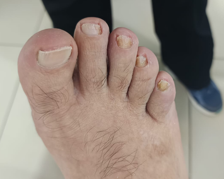 Corte de uñas