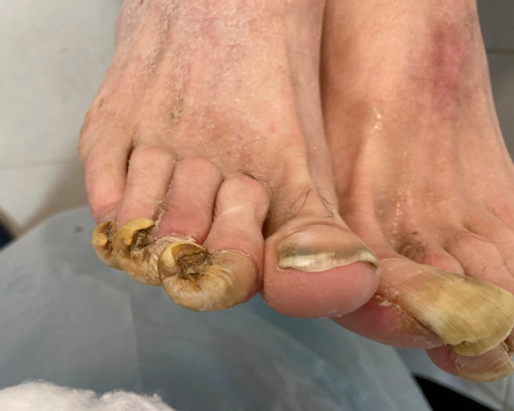 Onicogrifosis