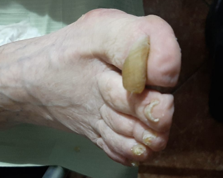 Onicogrifosis