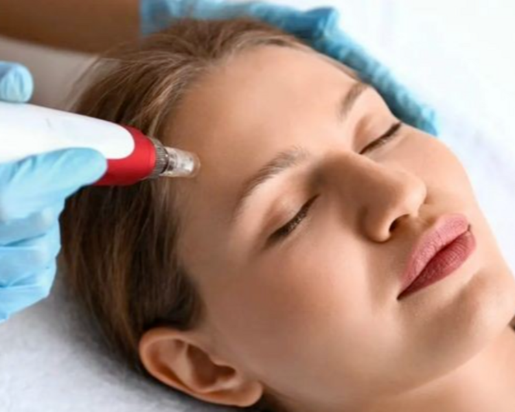 Microneedling- Dermapen