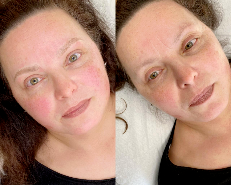 Nanoblading/Microblading