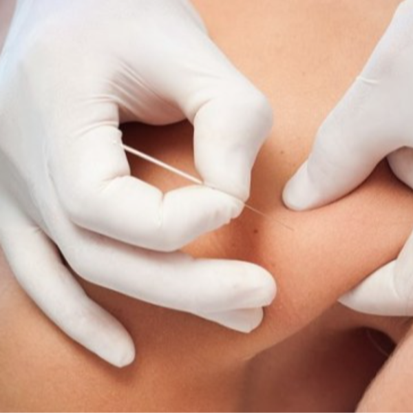 QUIROPRAXIA + FISIOTERAPIA INVASIVA (Incluye Técnica de Punción Seca-Ondas de Choque)