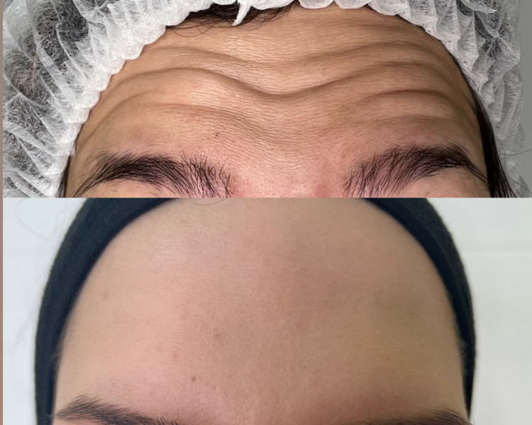 Toxina Botulínica (2 zonas) 