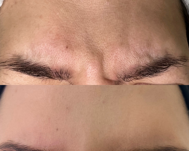 Toxina Botulínica (2 zonas) 