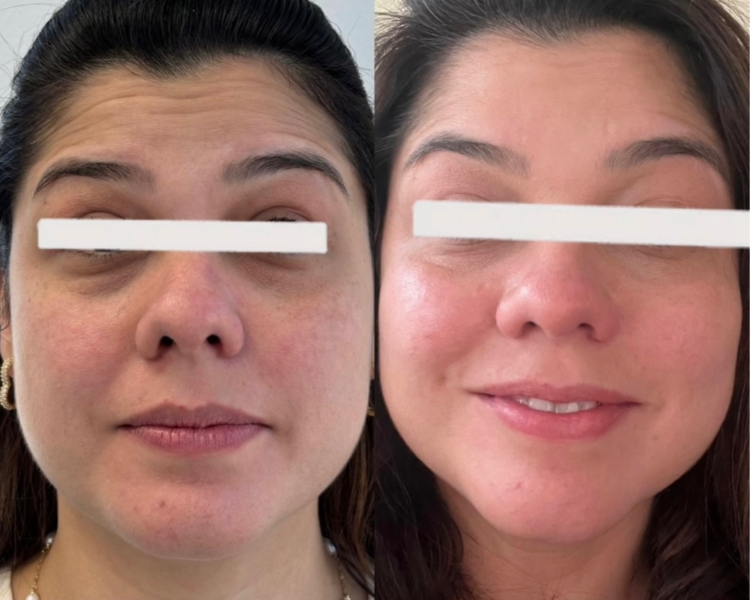 Full Face Toxina Botulínica (botox)
