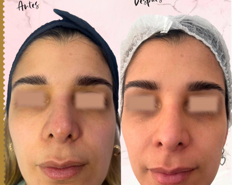 Bioestimulación de Colageno Hibrida (Hydroxy fill + Mesoheal)