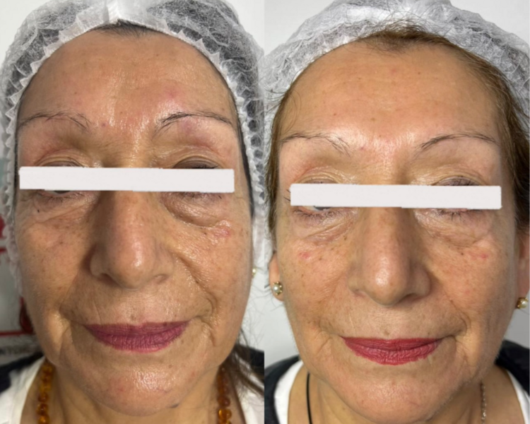 Bioestimulación de Colageno Hibrida (Hydroxy fill + Mesoheal)