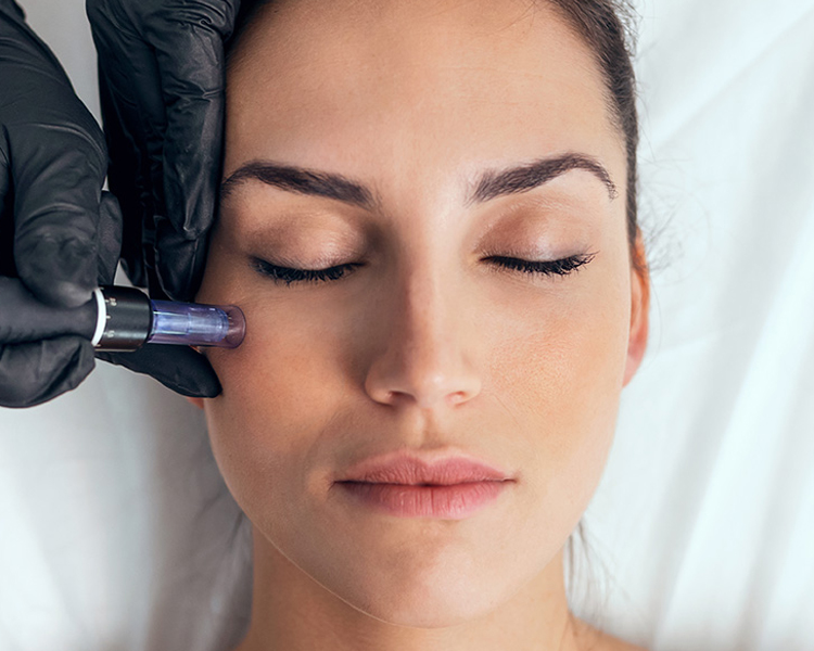 Dermapen rostro, cuello y escote (microneedling) 