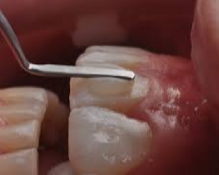 Restauraciones de Resina dientes anteriores