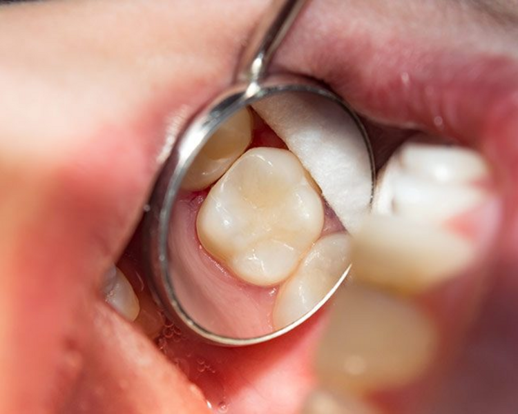 Restauración de Resina dientes posteriores