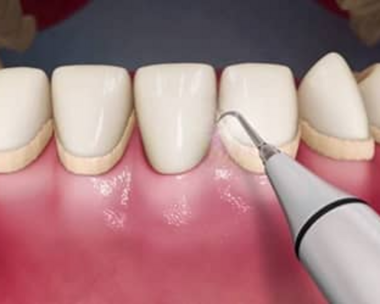 Limpieza profunda Detartraje