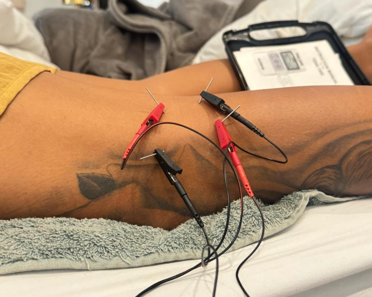 Punción seca y electro punción