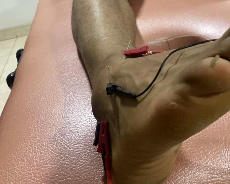 Punción seca y electro punción