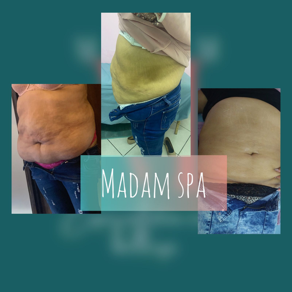 CARBOXITERAPIA Y APARATOLOGIA 5 EQUIPOS / 1 SESION