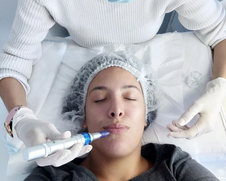 LIMPIEZA+MICRONEEDLING (DERMAPEN EN ROSTRO+PAPADA+CUELLO+ESCOTE)