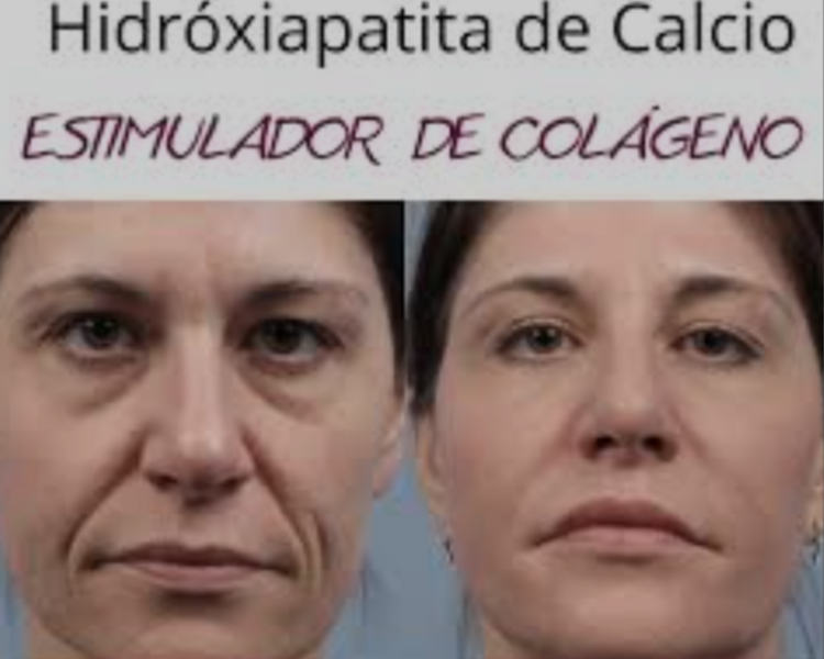 BIOESTIMULADOR FACETEM 1 jeringa