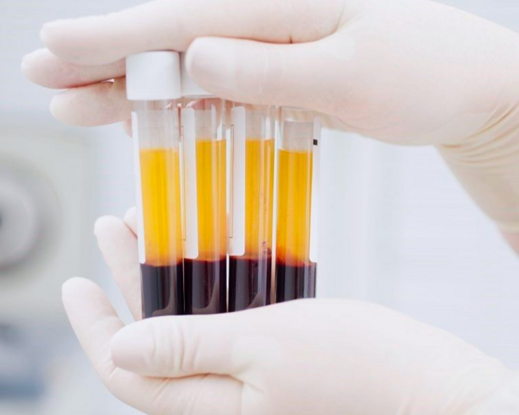 PLASMA RICO EN PLAQUETAS 3 SESIONES 