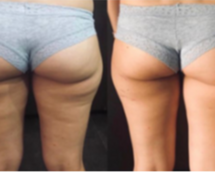 CELULITIS MESOTERAPIA POR ZONA