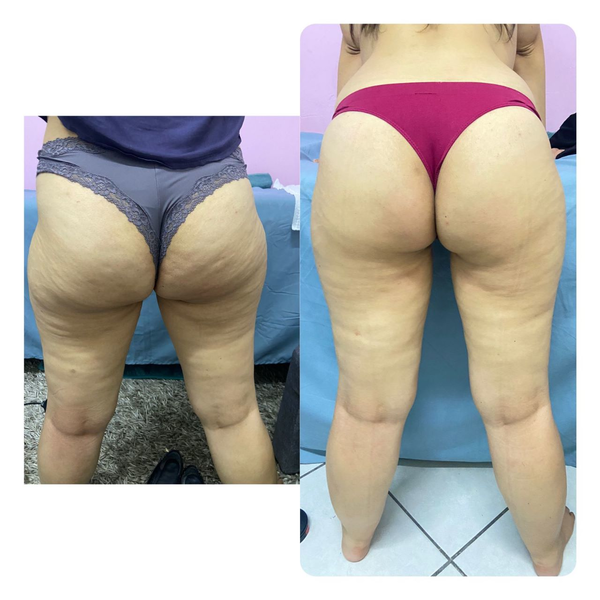 CARBOXITERAPIA 1 SESION