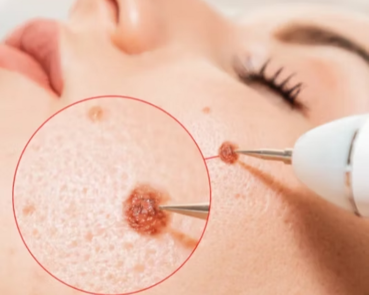 CAUTERIZACIÓN DE LUNAR