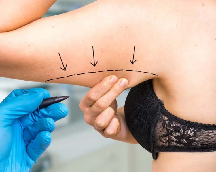 HIDROLIPOCLASIA BRAZOS