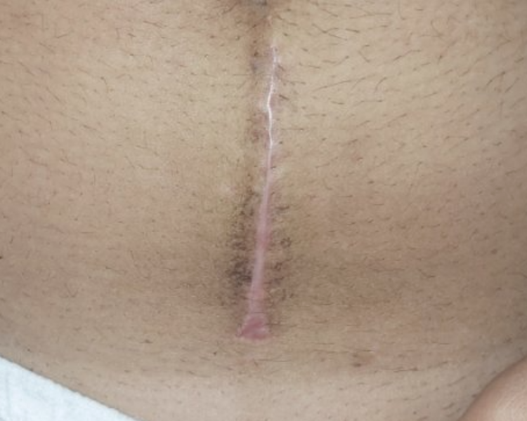 TRATAMIENTO PARA ESTRÍAS Y CICATRICES