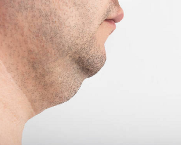 TRATAMIENTO REDUCTOR/TENSOR DE PAPADA