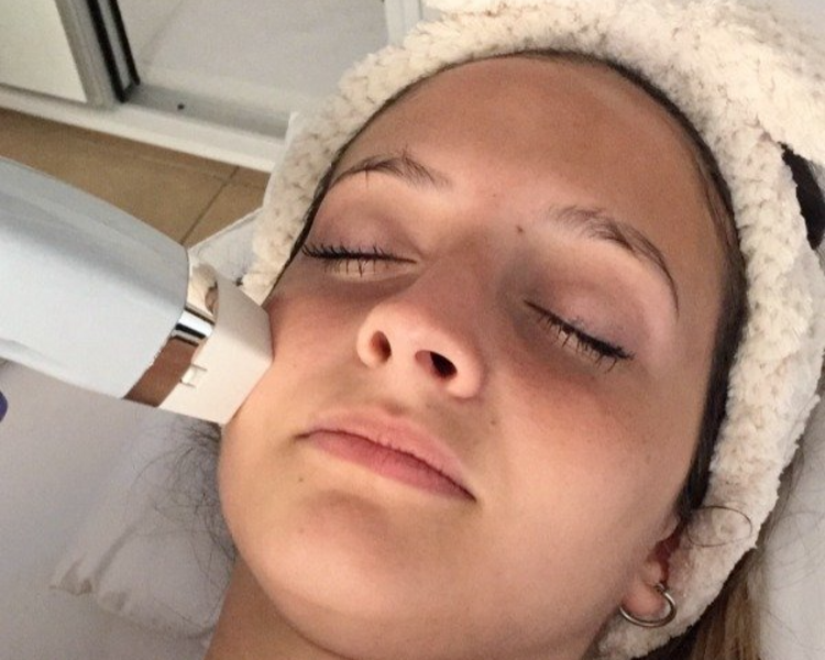 RADIOFRECUENCIA FRACCIONADA FACIAL