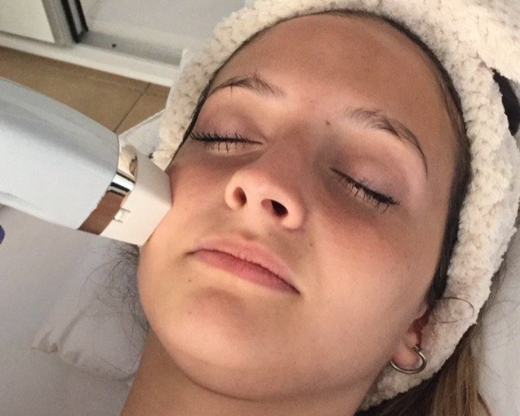 RADIOFRECUENCIA FRACCIONADA FACIAL, CUELLO, ESCOTE