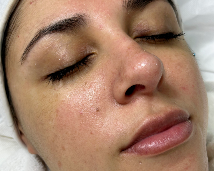 Limpieza facial con vitamina E y dermoabrasión