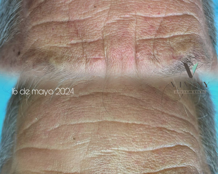 Fibroblast 1 zona mediana