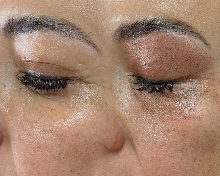 Fibroblast 1 zona pequeña