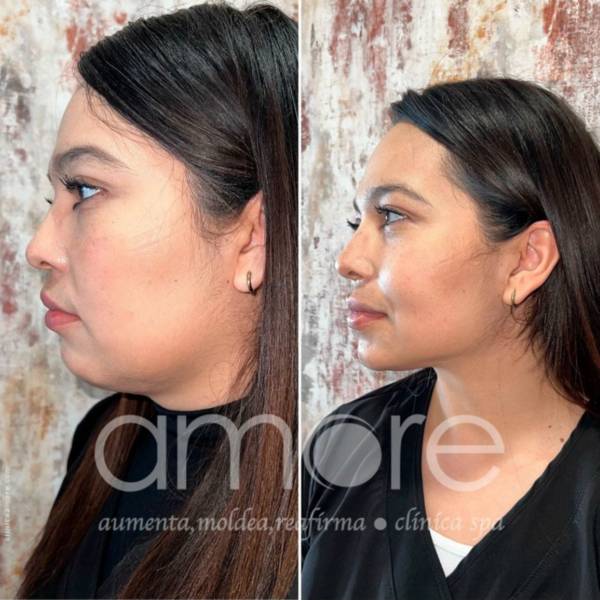 Enzimas Reductivas - 10 viales 