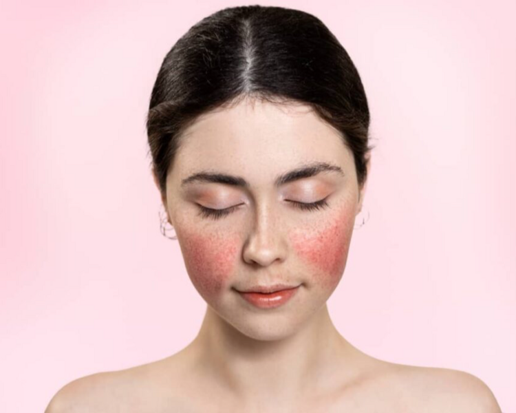 Limpieza facial Rosácea