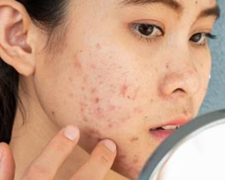 Limpieza facial acné