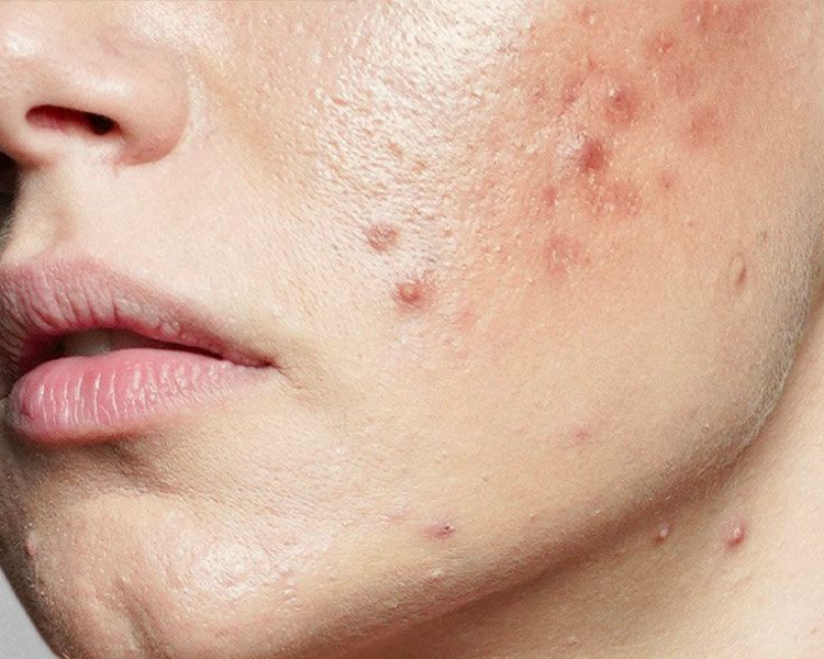 Piel Sensible con Acné