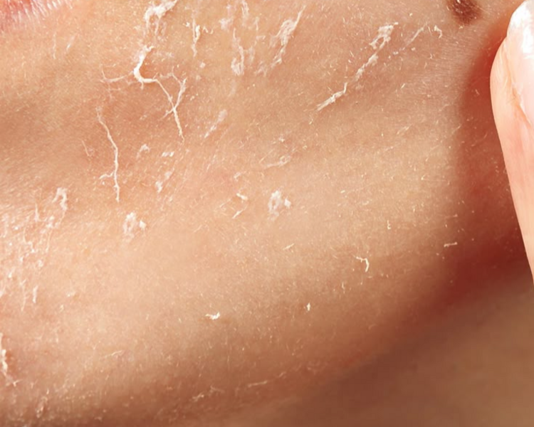 Temporada de Peelings + 2  Sesiones