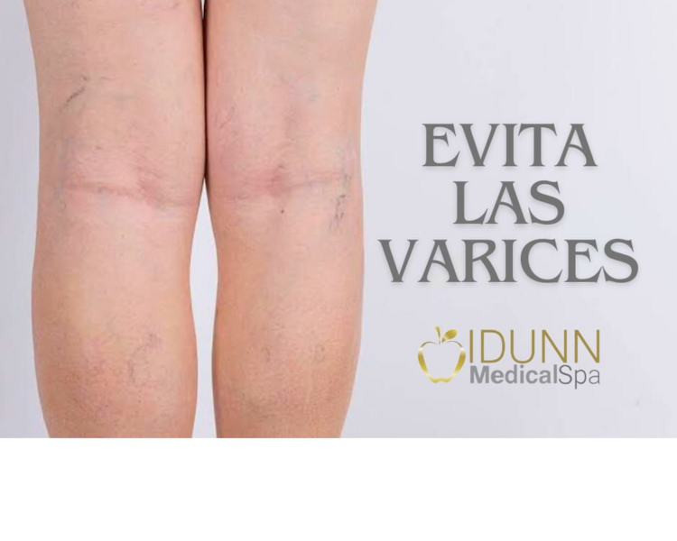 Escleroterapia Varices