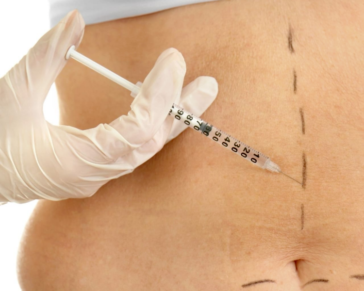 MESOTERAPIA CORPORAL + CAVITADOR