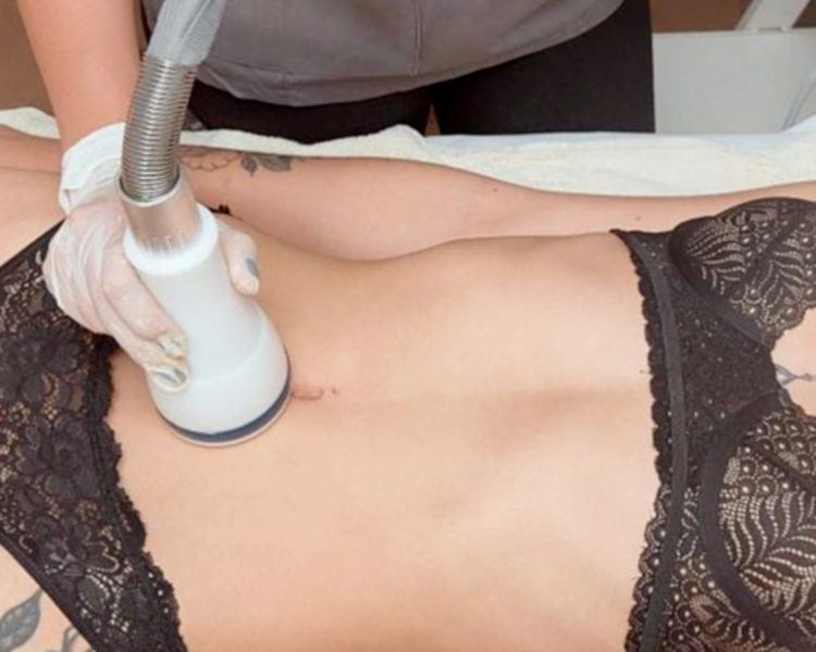 CRIORADIOFRECUENCIA CORPORAL CON MESOTERAPIA (1 ZONA)