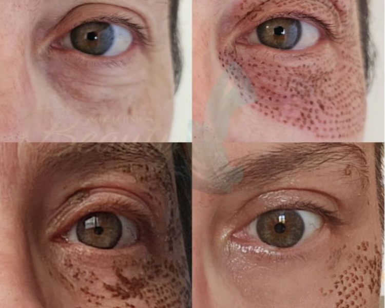 Fibroblast- Plasma Pen (por zona)