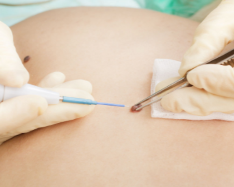 Cauterizacion Verrugas (eliminacion de verruga comun)